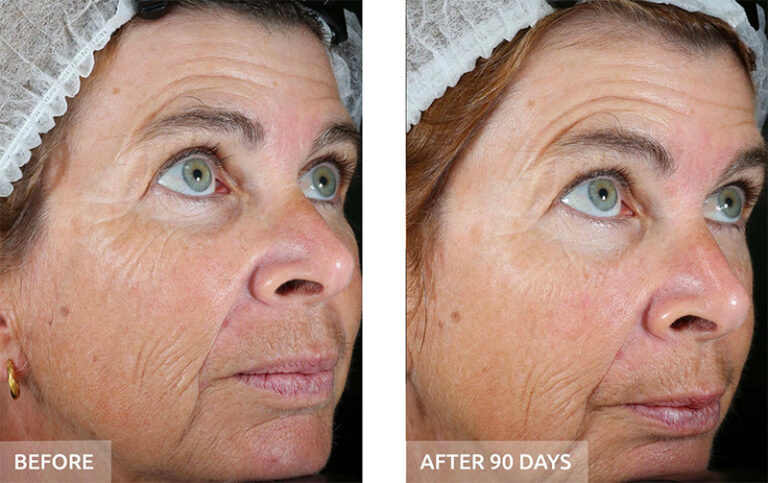 Before and after: loss of firmness
