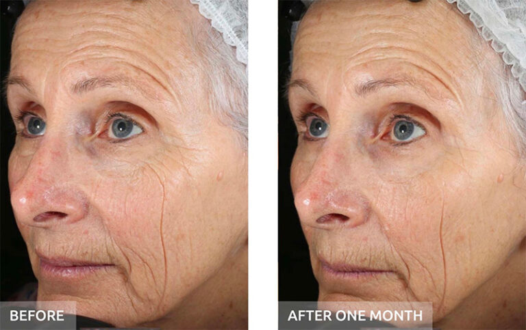Before and after: fine lines and wrinkles