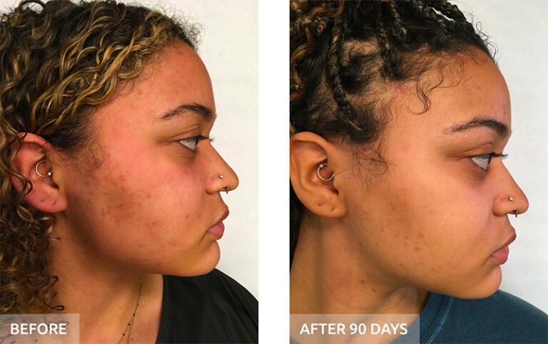 Before and after: texture and tone