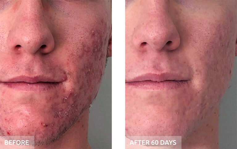 Before and after: acne and congestion